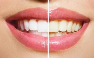 Why do teeth become discoloured?