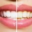 Why do teeth become discoloured?