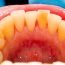 Why do we mean by plaque?