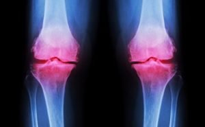 Why does Osteoarthritis take place?