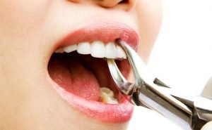 Why is it named 'wisdom teeth'?