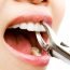 Why is it named 'wisdom teeth'?