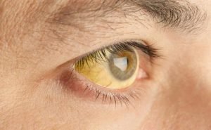 Why is it that people who suffer from jaundice turn yellow?