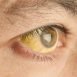Why is it that people who suffer from jaundice turn yellow?