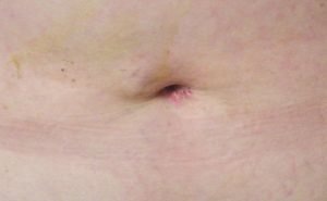 Will I be scarred after gall bladder operation?
