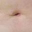 Will I be scarred after gall bladder operation?