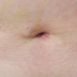 Will I be scarred after gall bladder operation?
