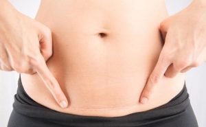 Will there be marks in case of caesarean ?